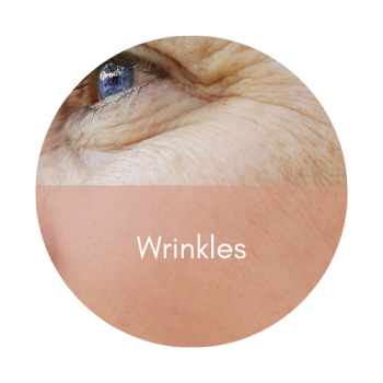 rejuran healer fine lines expression lines polynucleotide natural smoothness