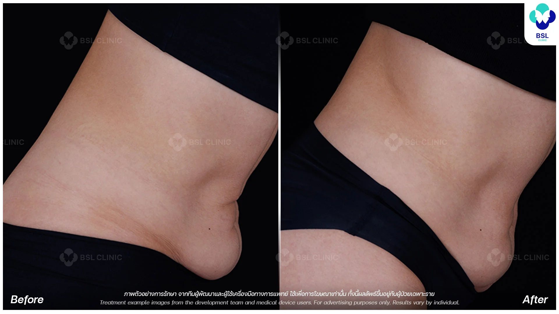 ultherapy-prime-ultherapy-before-and-after-waist-3-months-ultherapy-body-treatment-ultherapy-in-bangkok-ultherapy-thailand-ultherapy-bangkok-price-ulthera-bangkok-ultherapy-thailand-price-ultherapy-lower-abdomen-skin-tightening-results-non-invasive-body-lift-bsl-clinic