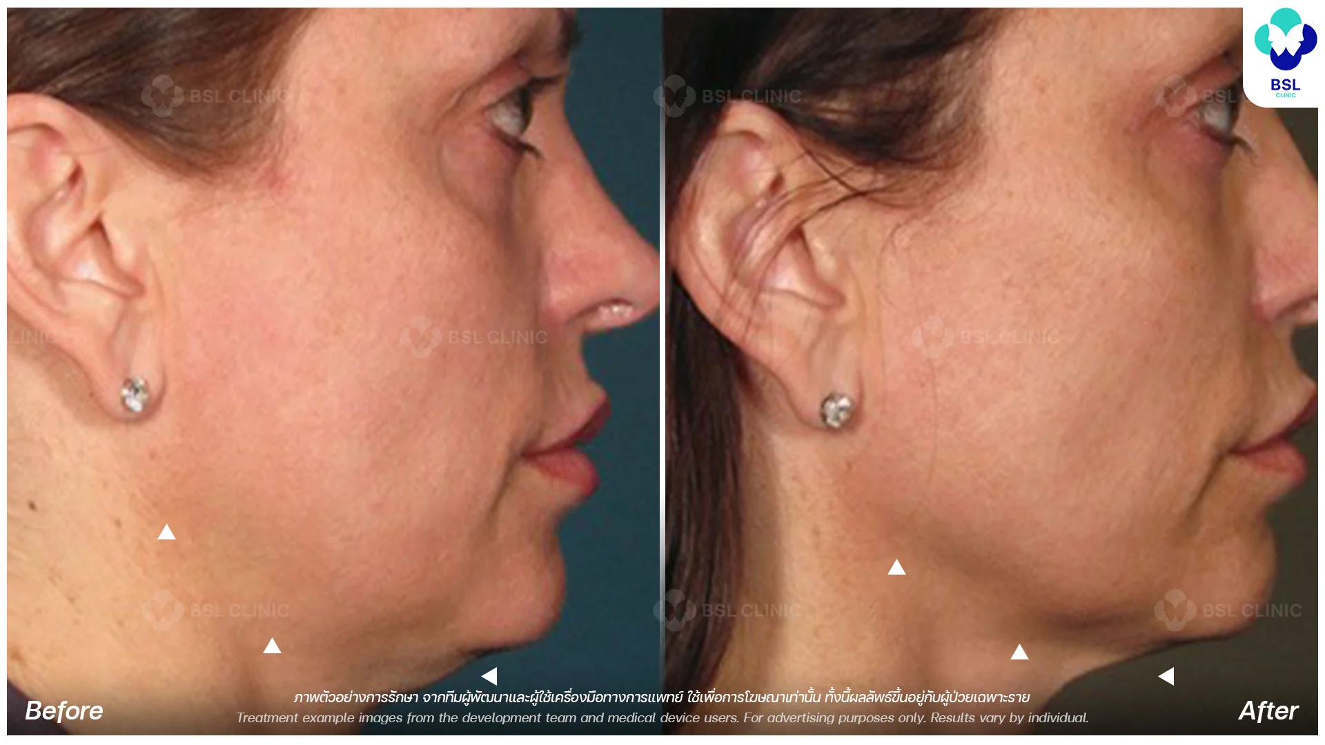 ultherapy-prime-before-and-after-90-days-under-chin-tightening-and-firming-results-ulthera-bangkok-ultherapy-thailand-price-ultherapy-bangkok-ultherapy-treatment-non-surgical-face-lift-ultherapy-before-and-after-bangkok