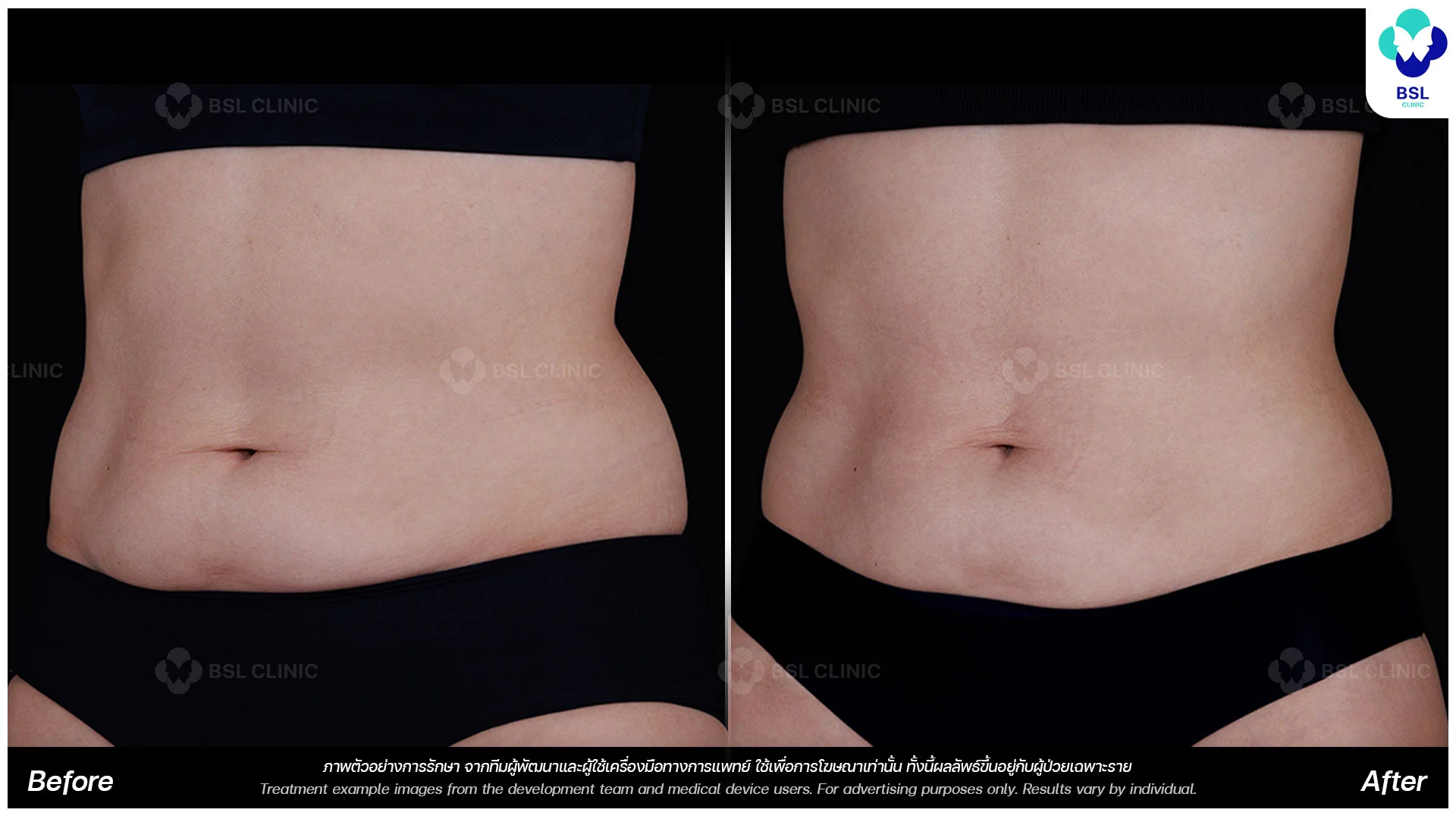 ultherapy-prime-before-and-after-3-months-abdomen-skin-tightening-body-firming-results-ulthera-bangkok-ultherapy-in-bangkok-ultherapy-thailand-non-invasive-body-lifting-ultherapy-treatment-ultherapy-bangkok-price-ultherapy-before-and-after-body