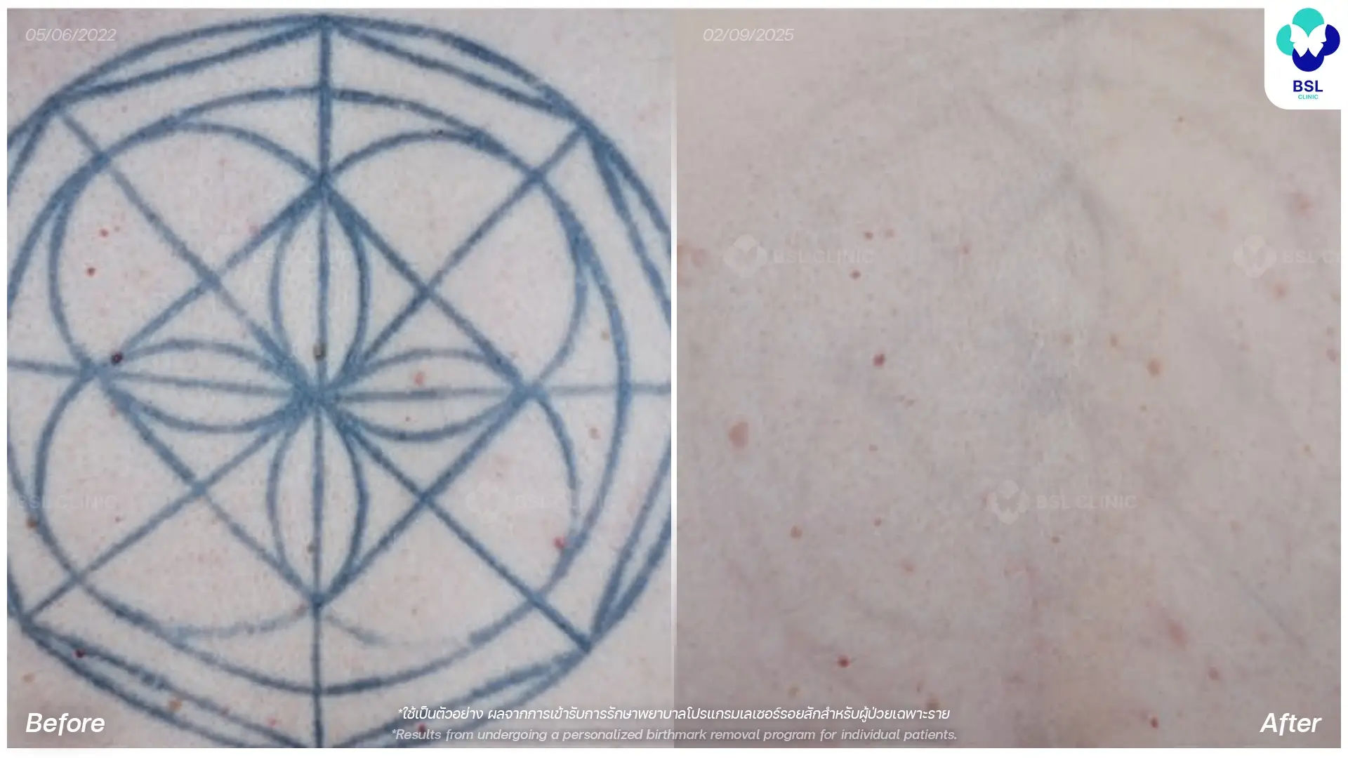 before and after picoway laser tattoo removal bangkok thailand blue ink geometric tattoo six months results pico laser tattoo removal thailand laser tattoo removal clinic bangkok