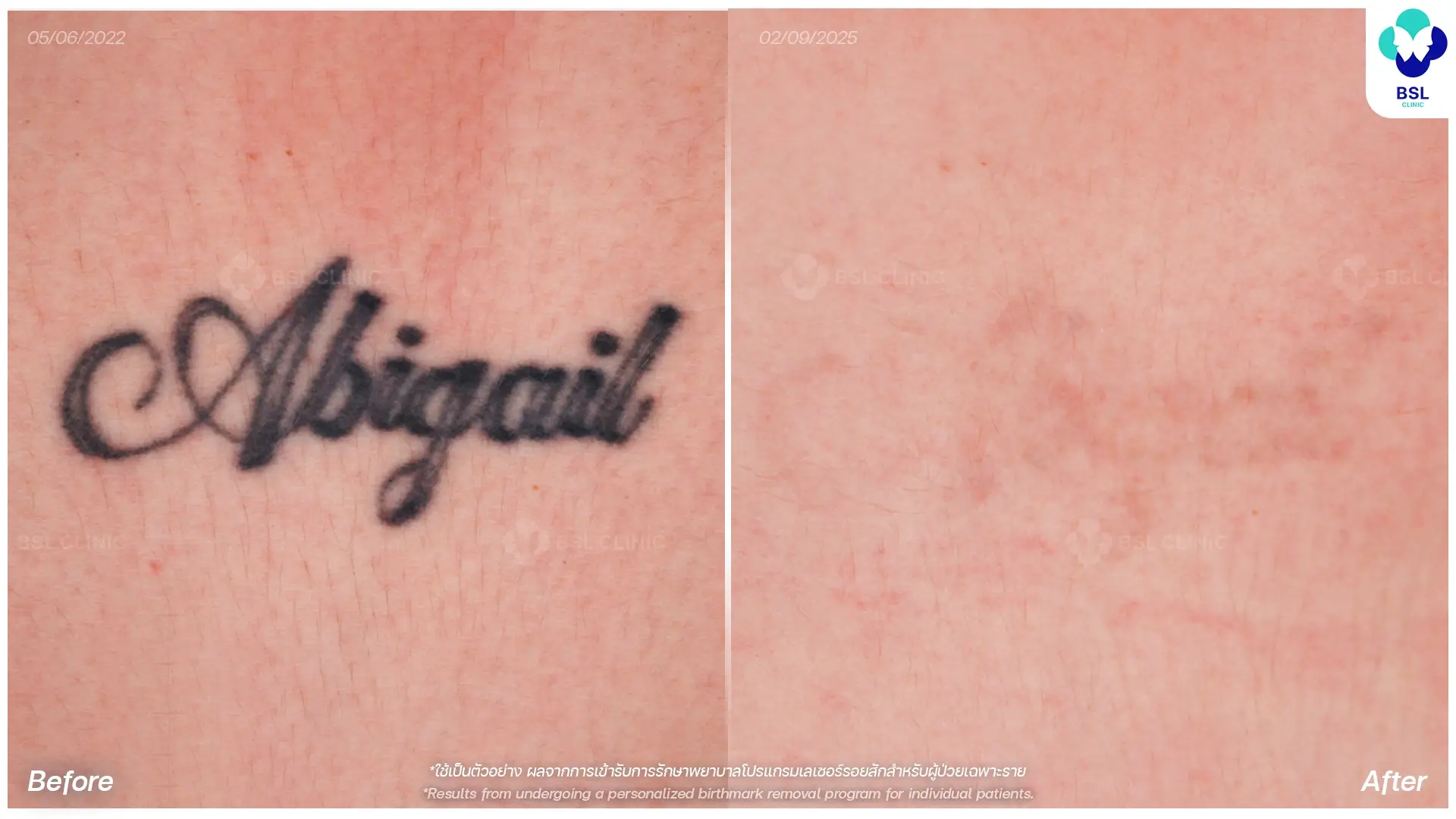 black name tattoo abigail before and after picoway laser tattoo removal in bangkok thailand laser tattoo removal results six months after treatment pico laser tattoo removal bangkok