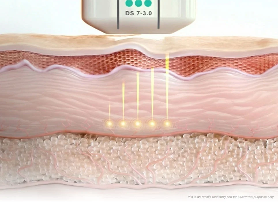 ultherapy-prime-non-invasive-face-lift-deep-dermis-collagen-renewal-ultherapy-before-and-after-ultherapy-in-bangkok-ultherapy-bangkok-price-ulthera-bangkok-ultherapy-treatment-best-ultherapy-in-bangkok-ultherapy-face-lift-cost-ultherapy-thailand-price-ultherapy-bangkok-ulthera-thailand-collagen-elastin-regeneration-fibroblast-skin-tightening