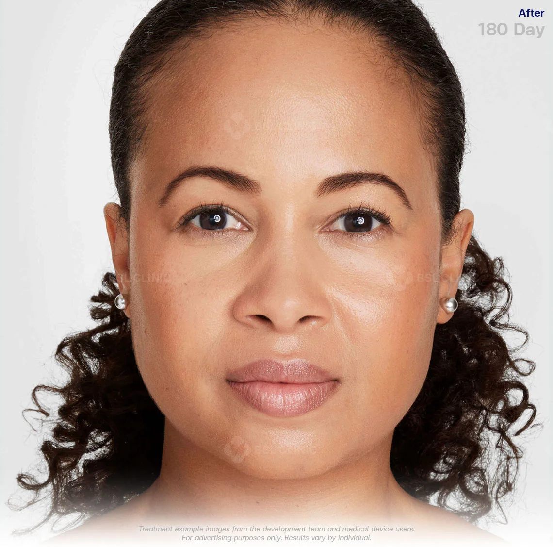 ultherapy-prime-before-and-after-180-days-visible-results-ultherapy-in-bangkok-ulthera-bangkok-ultherapy-face-lift-cost-non-invasive-ultrasound-lifting-ultherapy-bangkok-price-ultherapy-thailand-best-ultherapy-results
