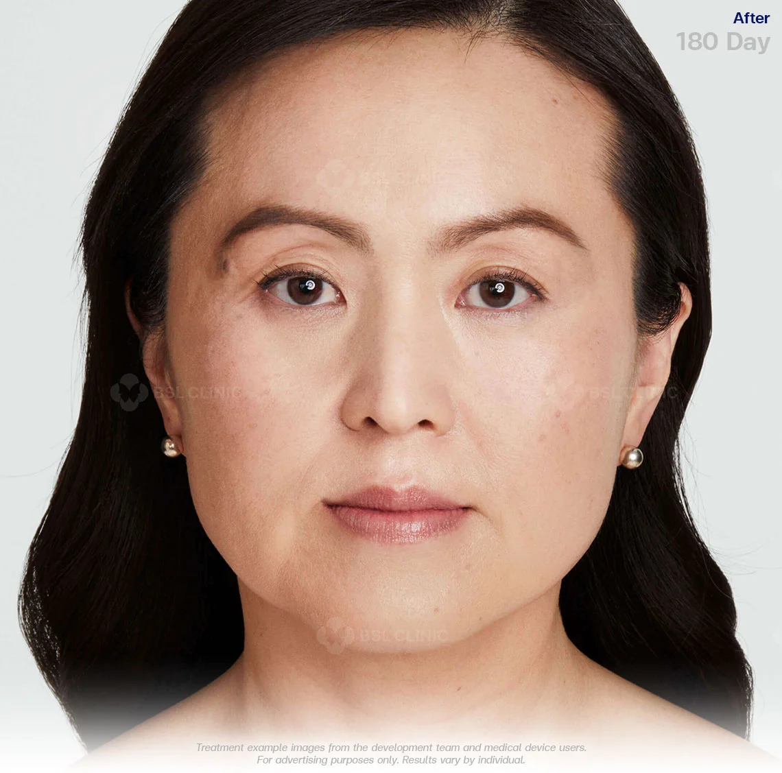 ultherapy-prime-before-and-after-results-180-days-ulthera-bangkok-ultherapy-bangkok-price-non-invasive-face-lift-ultherapy-treatment-ultherapy-thailand-ultherapy-face-lift-cost-ultherapy-bangkok-best-ultherapy-in-bangkok