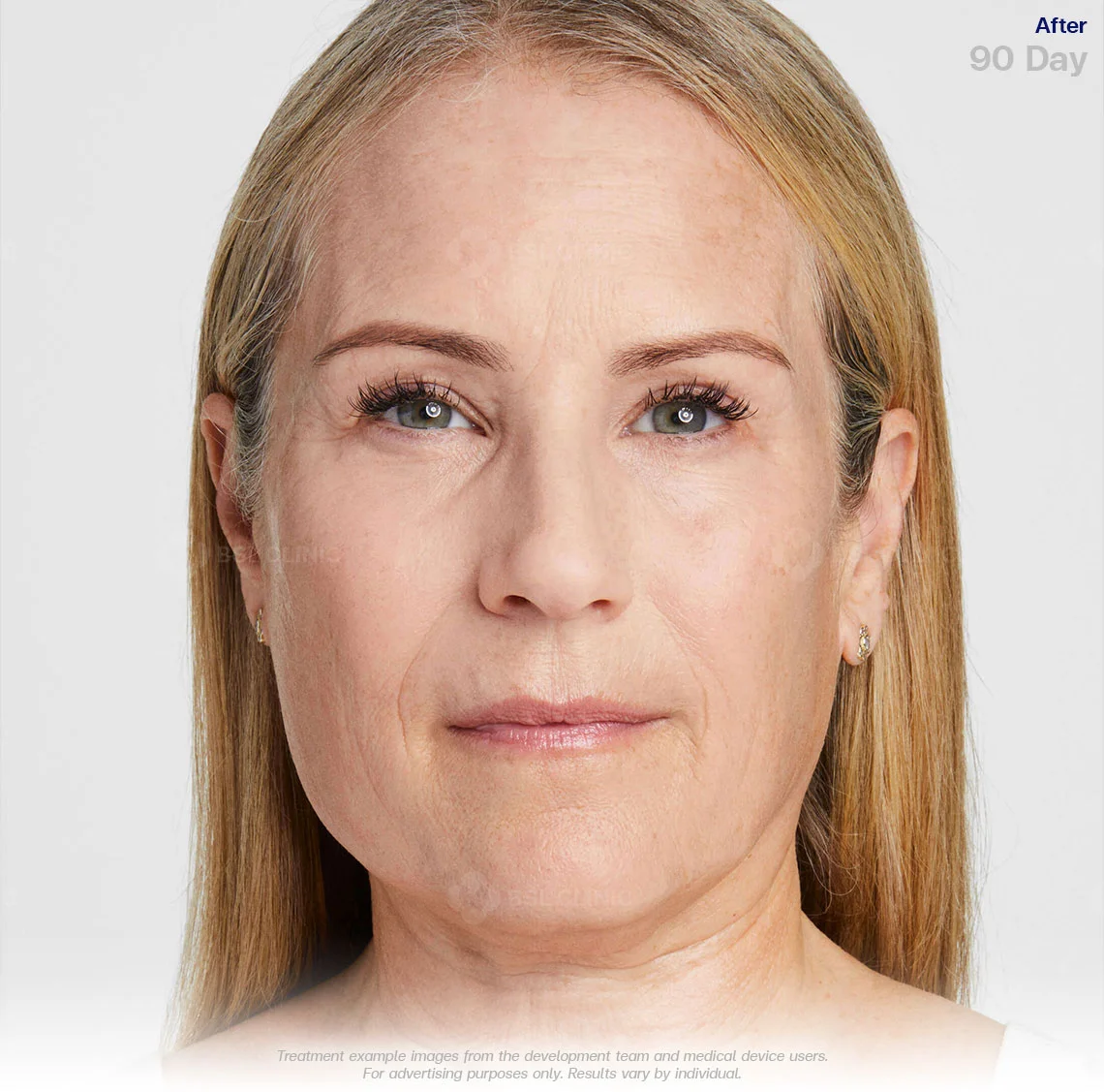 ultherapy-prime-ultherapy-before-and-after-90-days-ultherapy-results-non-invasive-face-lift-ultherapy-in-bangkok-ulthera-bangkok-ultherapy-bangkok-price-ultherapy-face-lift-cost-ultherapy-treatment-ultherapy-thailand-best-ultherapy-in-bangkok-ultherapy-thailand-price-ultherapy-bangkok-skin-tightening-collagen-renewal-results