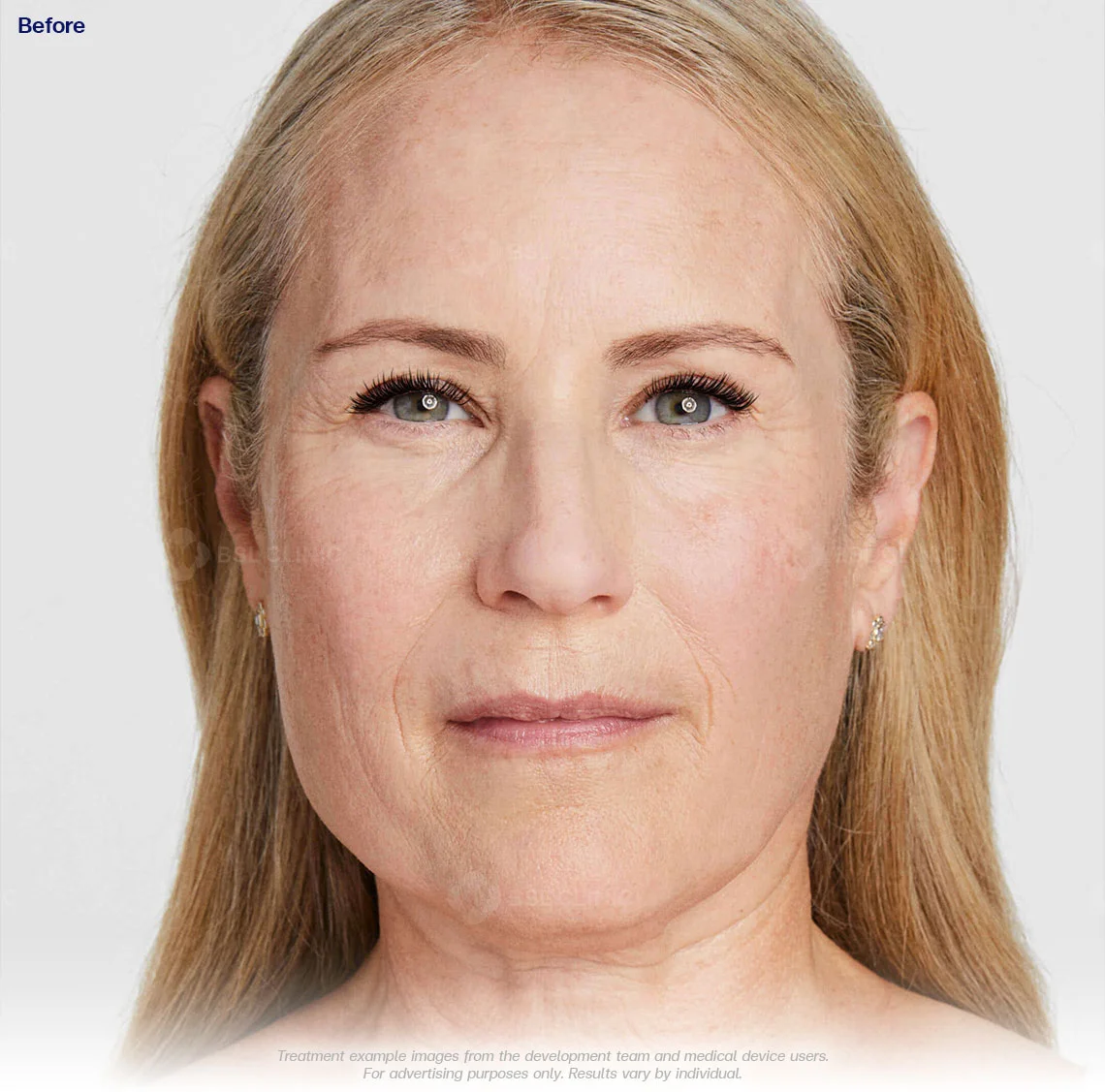 ultherapy-prime-ultherapy-before-and-after-90-days-ultherapy-results-non-invasive-face-lift-ultherapy-in-bangkok-ulthera-bangkok-ultherapy-bangkok-price-ultherapy-face-lift-cost-ultherapy-treatment-ultherapy-thailand-best-ultherapy-in-bangkok-ultherapy-thailand-price-ultherapy-bangkok-skin-tightening-collagen-renewal-results