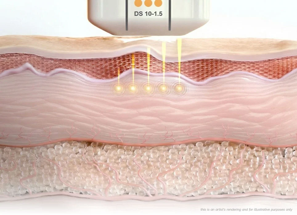 ultherapy-prime-ultherapy-non-invasive-face-lift-superficial-dermis-1-5mm-collagen-renewal-ultherapy-before-and-after-ultherapy-in-bangkok-ultherapy-bangkok-price-ulthera-bangkok-ultherapy-treatment-ultherapy-thailand-best-ultherapy-in-bangkok-ultherapy-face-lift-cost-ultherapy-thailand-price-ultherapy-bangkok-skin-texture-refinement-decollete-collagen-elastin-stimulation