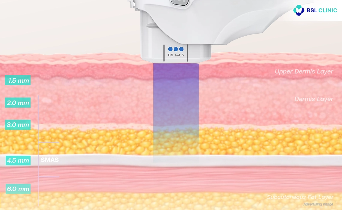 Targets-the-SMAS-layer-Thermage-vs-Ultherapy