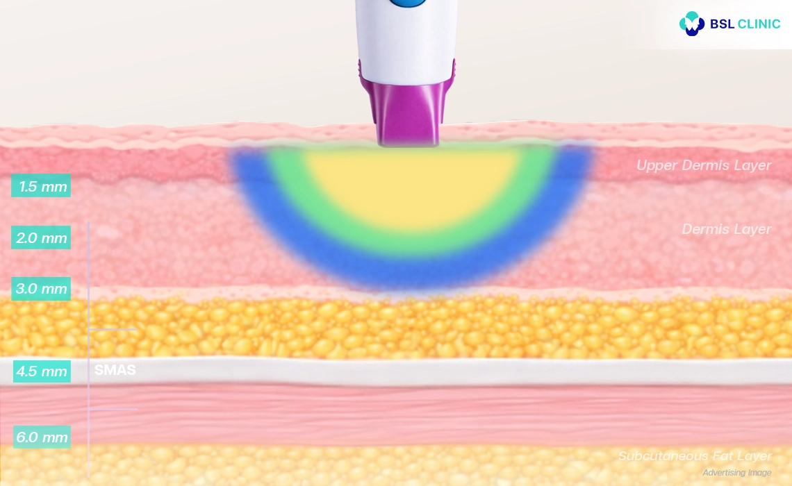 Thermage FLX Program-Targets the dermis and fat layer