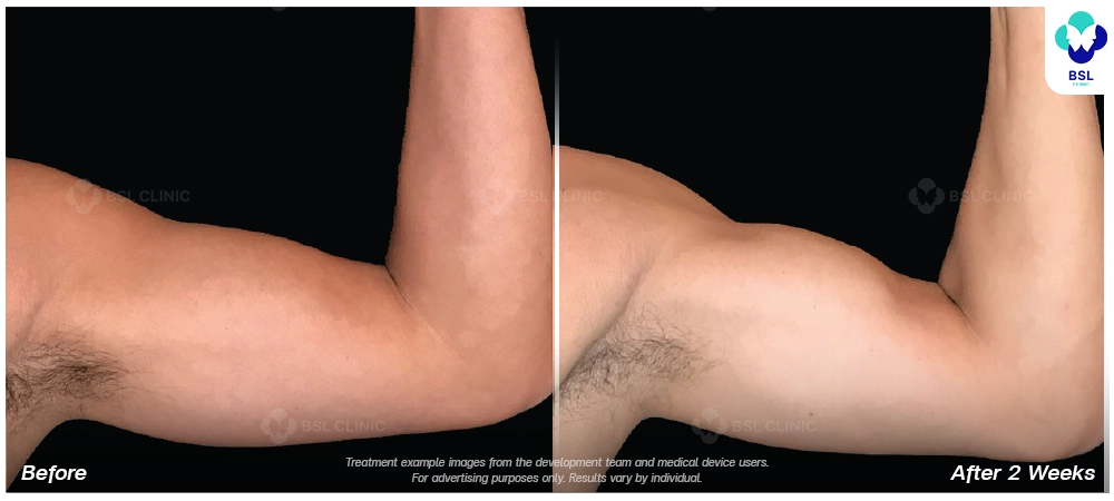 emsculpt neo before after results 11