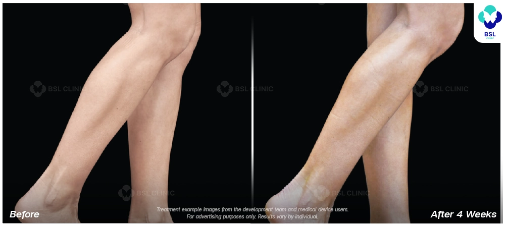 emsculpt neo before after results 12