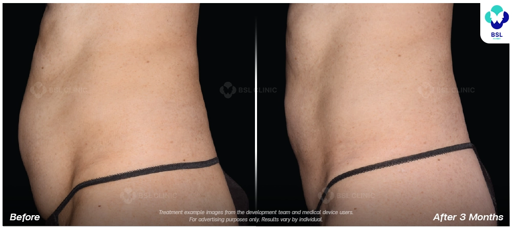 emsculpt neo before after results 3 1
