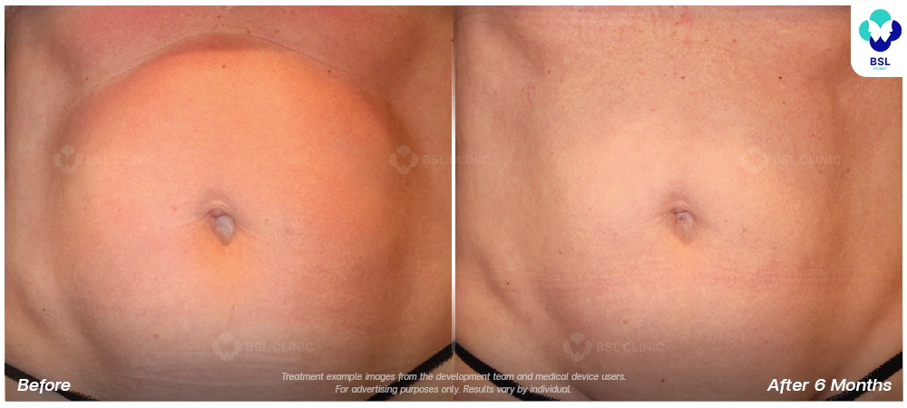 emsculpt neo before after results 4 1