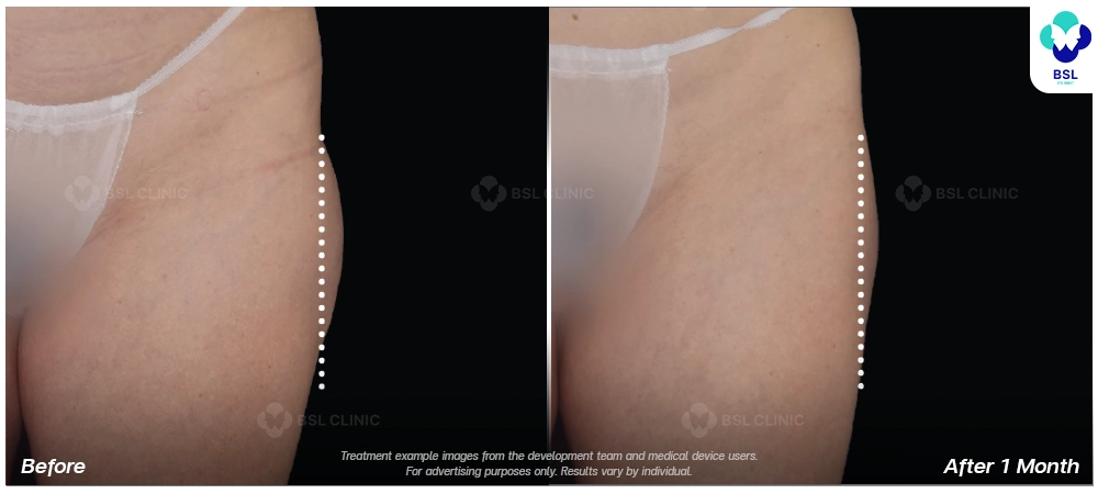 emsculpt neo before after results 5