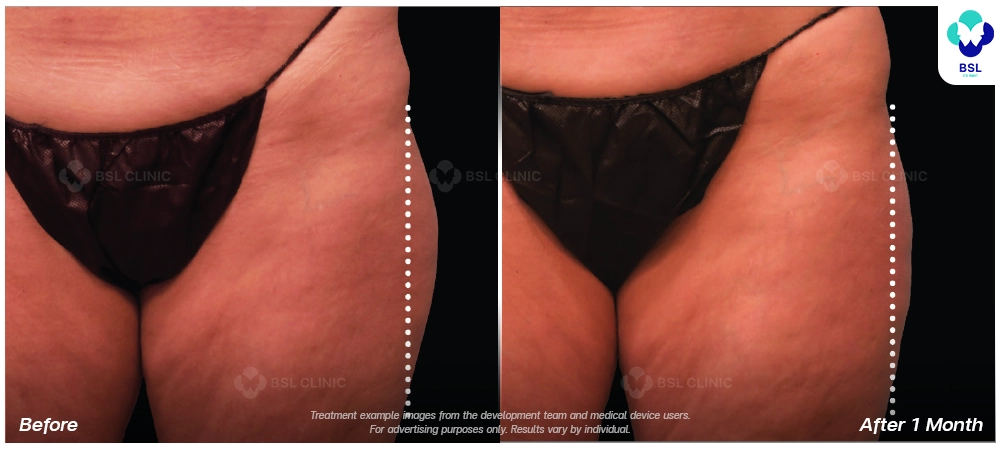 emsculpt neo before after results 6
