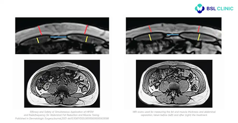 Abdominal Contouring &mdash; Multicenter MRI Study