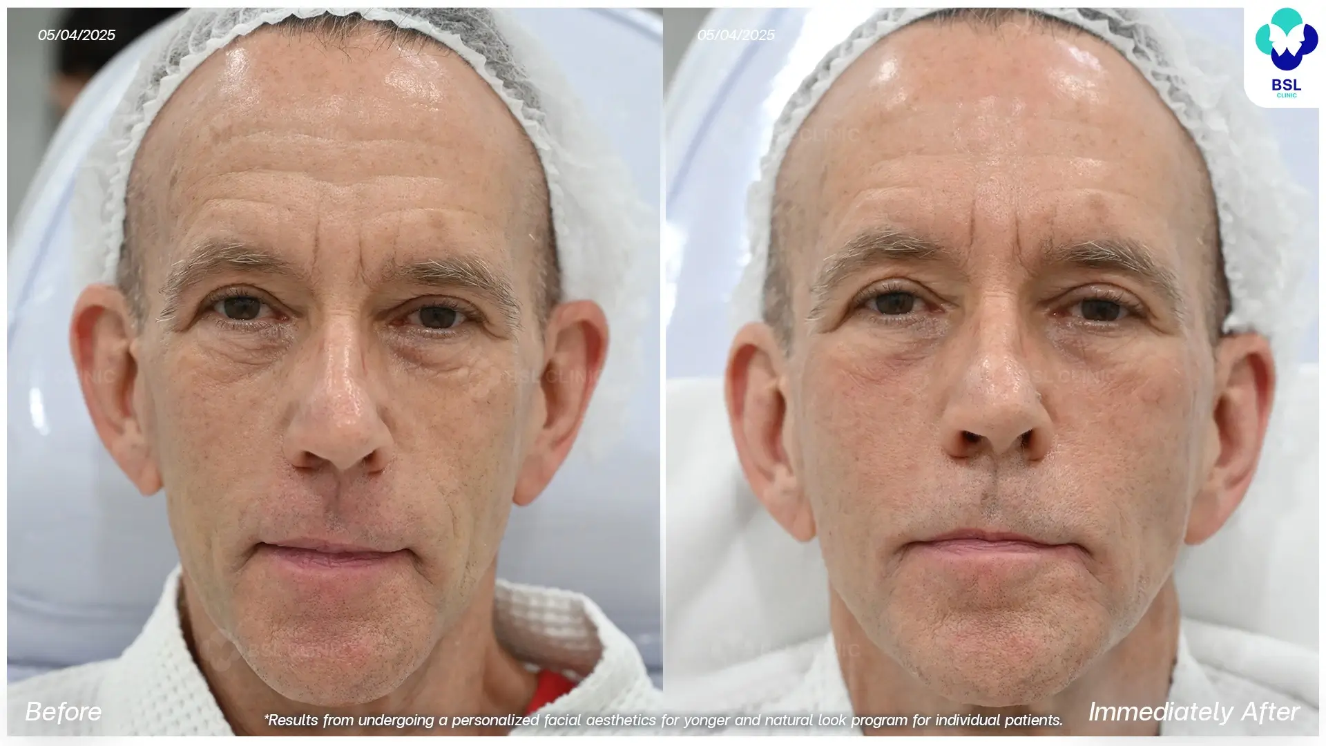 BA Face Lifting 580287 L Edward Kneip edit