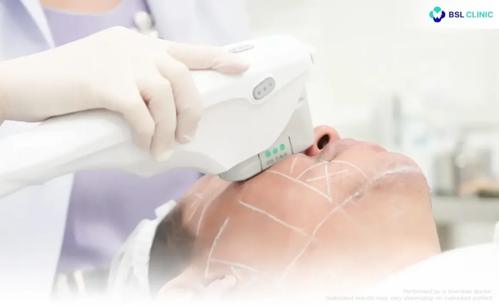 Ultherapy Prime Program
