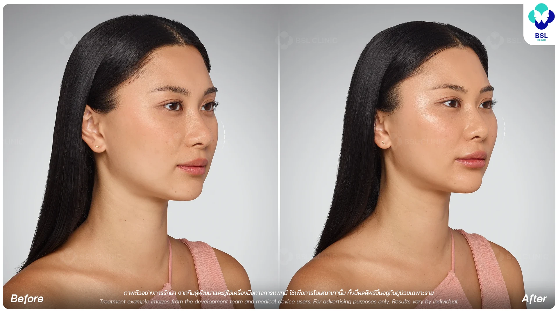 Cheek Filler Program for Softer Facial Profile