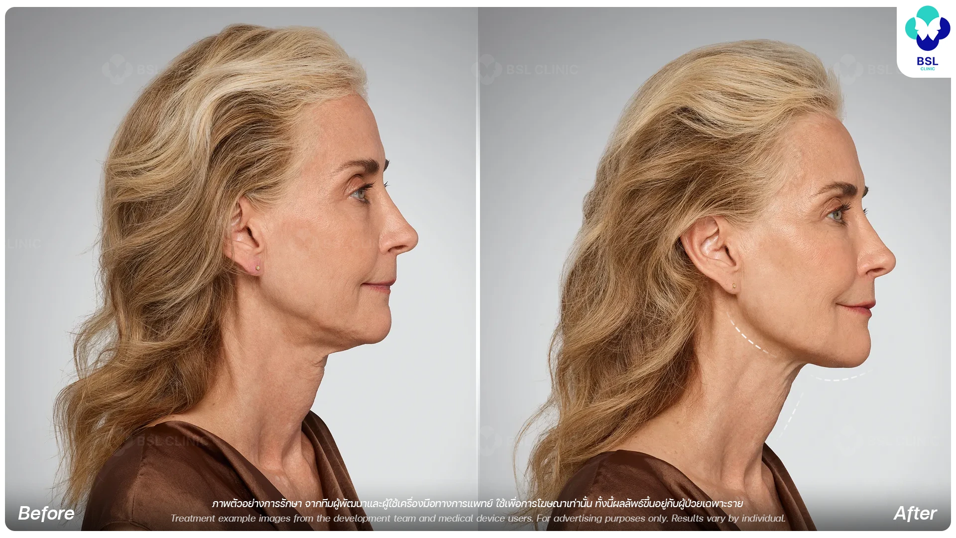 HA-Filler-Program-Jawline-&-Chin-Filler-Program-for-Facial-Definition