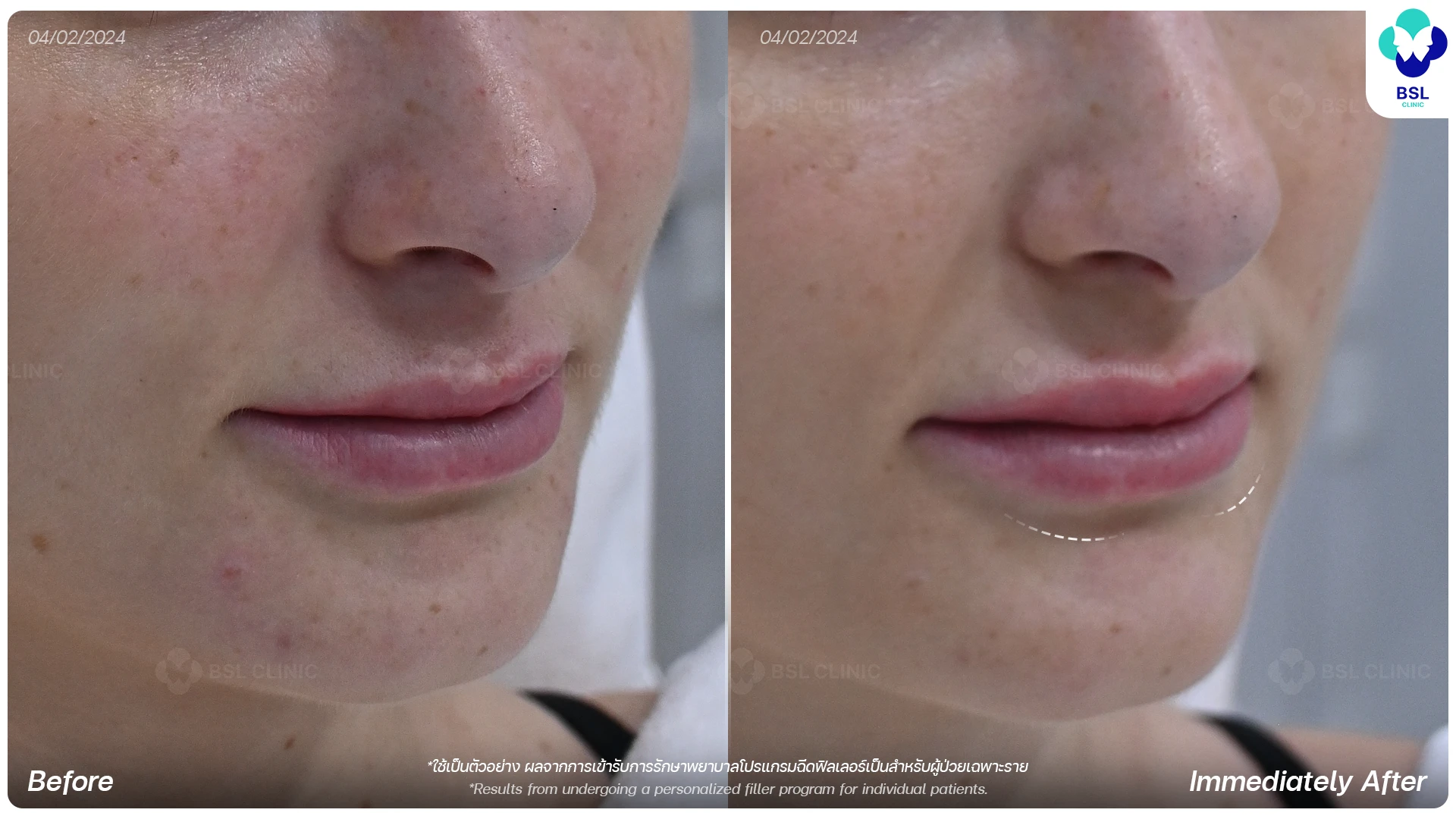 HA-Filler-Program-Lip-Filler-Program-for-Natural-Lip-Contour