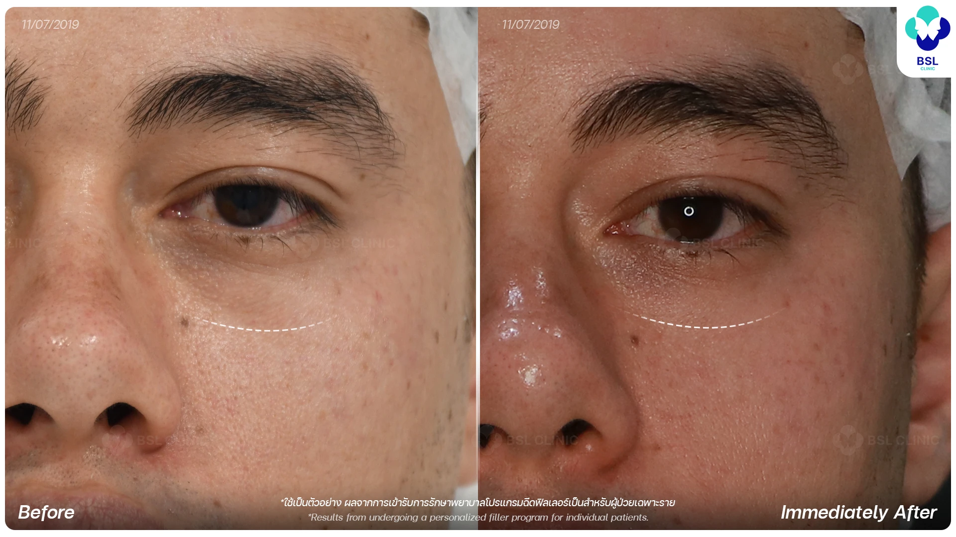 Under Eye Filler Program for Tired-Looking Eyes