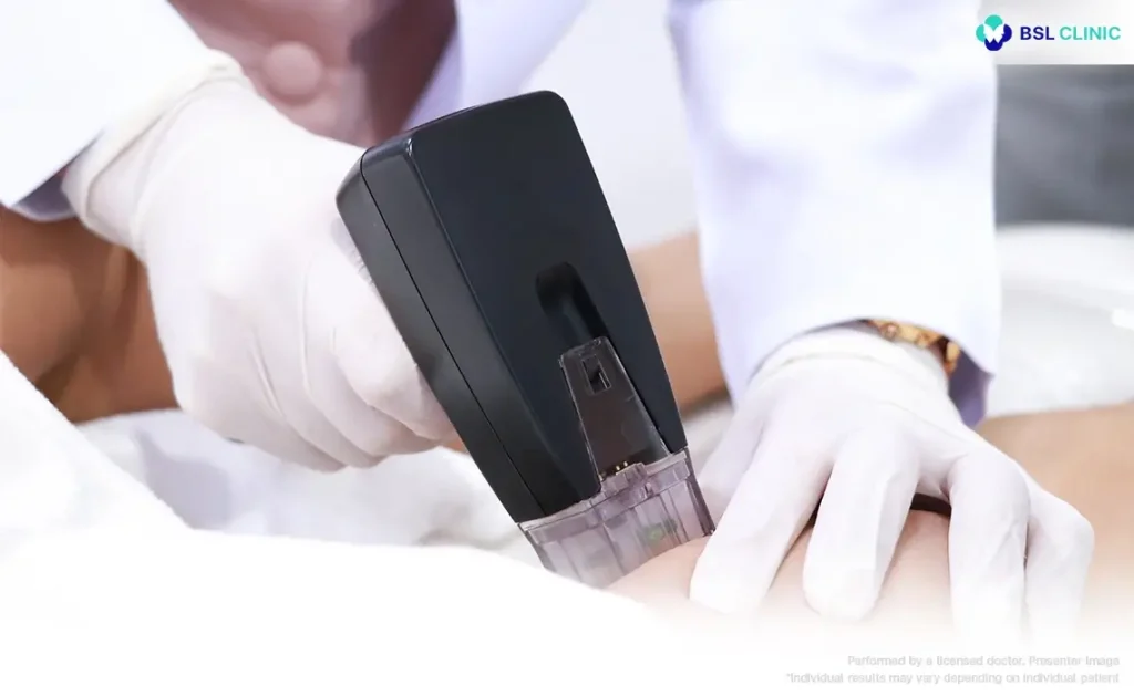 Microneedling RF for structural lifting and texture refinement 1024x629
