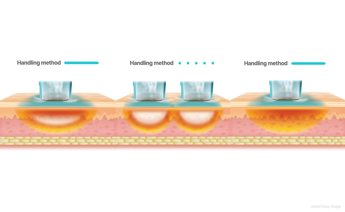 RF tightening for smoother, refined skin texture Oligio X Program